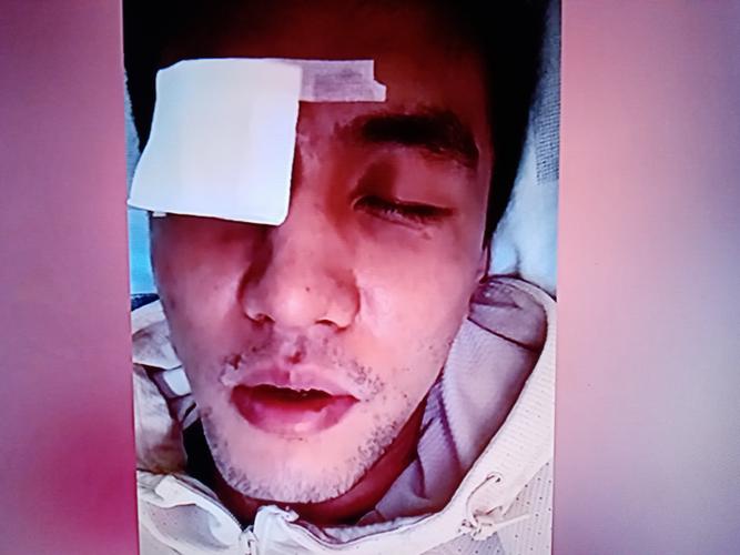 上一场被阿门误伤的小贾中场接受采访右眼眶布满血丝